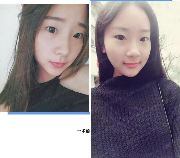 成都铜雀台割双眼皮怎么样？先来看看杨建医生的案例吧！