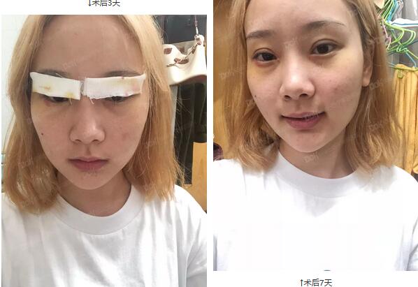 成都铜雀台割双眼皮怎么样？先来看看杨建医生的案例吧！