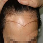 卢相勋医生植发技术怎么样?能改变我这大额头吗? width=
