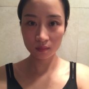 惠州鹏爱医院做下颌角整形的技术如何?能值得信赖吗? width=