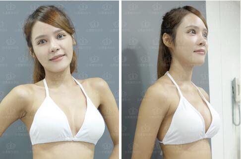 盛宗顺医生做双眼皮怎么样？一起来看看这篇案例吧！