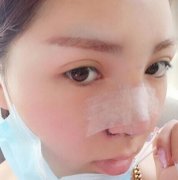 沈阳军区总医院整形科【价目表】还有隆鼻案例对比 width=