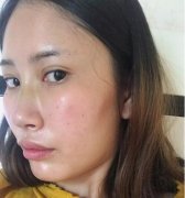 侧面照嘴凸龅牙，存钱三个月，拔牙做隐形矫正！ width=