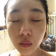 鼻唇沟微整形果怎么样?真实案例分享~ width=