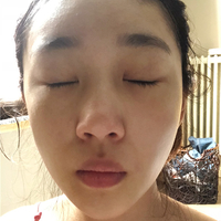 鼻唇沟微整形果怎么样?真实案例分享~