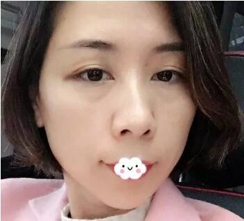 米兰柏羽刘晓辞医生怎么样?自体填充案例展示~