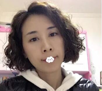 米兰柏羽刘晓辞医生怎么样?自体填充案例展示~