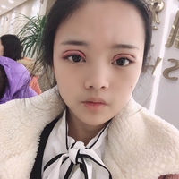 盛宗顺医生做双眼皮怎么样?真人案例展示~