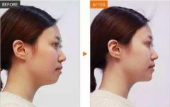伊维兰丰下巴的价格高吗？一起来看看有哪些影响因素吧！ width=