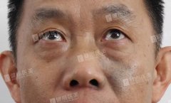 微创去眼袋果好吗？50岁蔡叔做后果好到爆！ width=