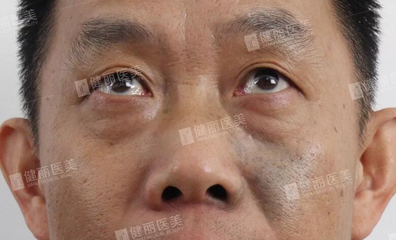 微创去眼袋果好吗？50岁蔡叔做后果好到爆！