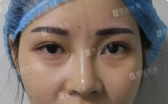 健丽微创去眼袋技术后晒出自拍视频，闺蜜看完都不敢相信？！ width=