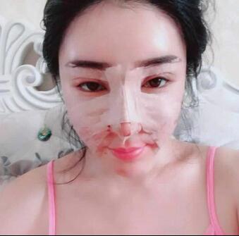 假体隆鼻日记90天全纪录