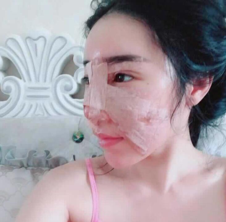 假体隆鼻日记90天全纪录