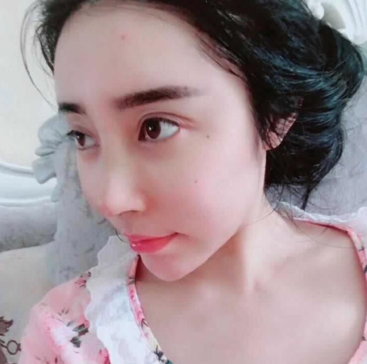 假体隆鼻日记90天全纪录