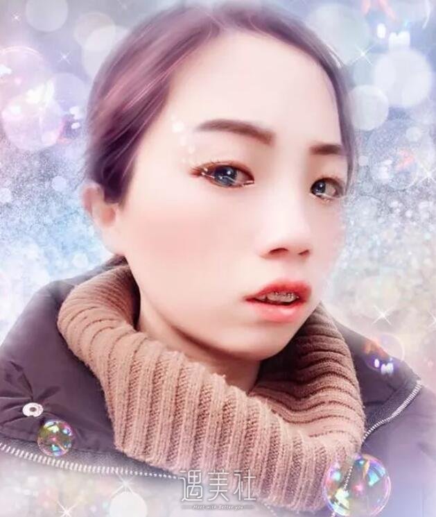 正畸凸嘴矫正案例分享，亲身讲述我的变化史!