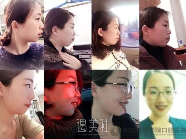 正畸凸嘴矫正案例分享，亲身讲述我的变化史!