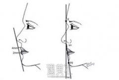 驼峰鼻矫正价钱是多少了?货比三家多看看价格 width=