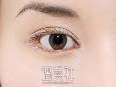 生物焊接双眼皮多少钱?影响价格的因素有哪些? width=