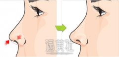 朝天鼻矫正果怎么样，做一次需要多少钱? width=