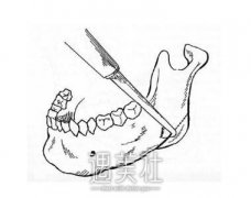 肥胖下颌骨整形果怎么样? width=