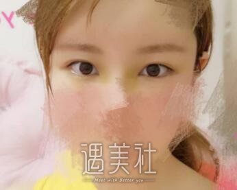 安贞医院整形李斌斌眼部手术案例