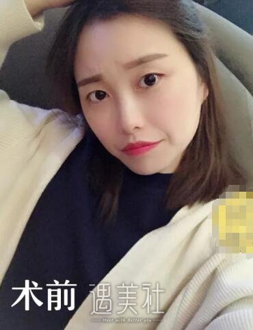 胡琼华博士双眼皮案例分享，甩掉单眼皮就这么简单!