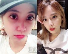 胶原蛋白补充泪沟真实体验：一针赶走我的疲倦感~ width=