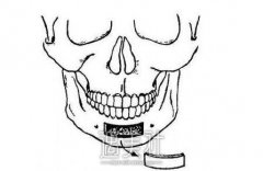 下颌骨整形风险是不是很大，怎么避免风险? width=