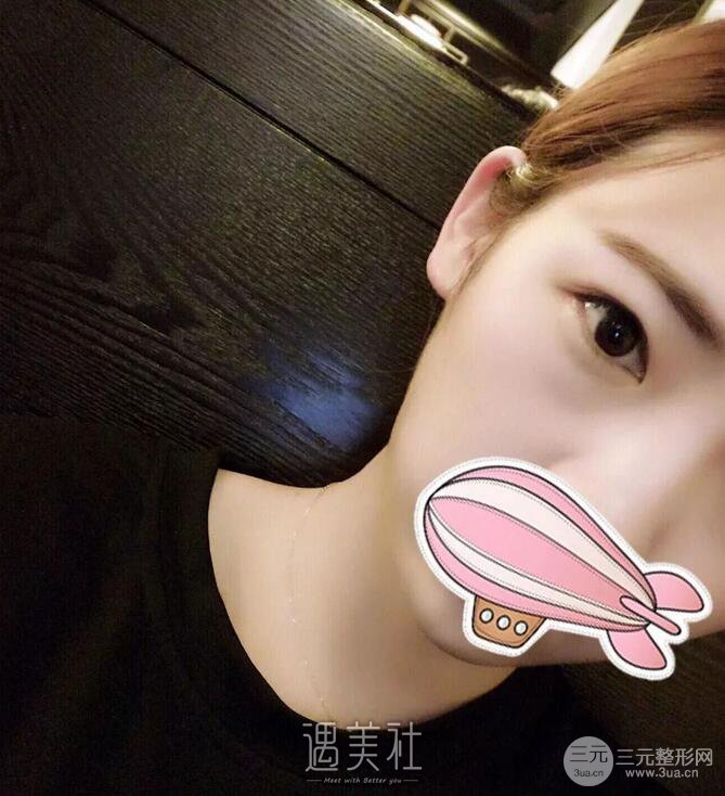 安贞医院李文志医生怎么样？双眼皮案例硬核证明实力！