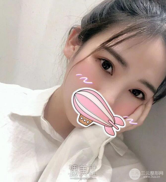 安贞医院李文志医生怎么样？双眼皮案例硬核证明实力！
