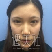 鼻唇沟微整形后的果如何?能否让我年轻数十岁? width=