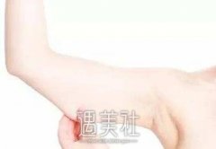共振吸脂瘦胳膊果怎么样，好不好? width=