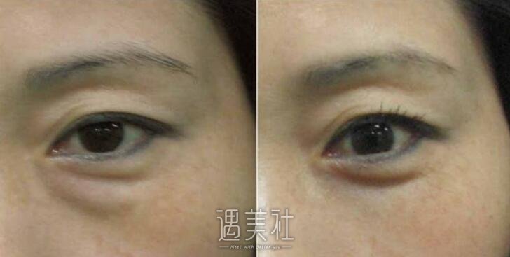 吸脂去眼袋有副作用吗?整理下吸脂去眼袋的副作用~