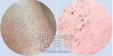 黑脸娃娃可以去痘印吗?黑脸娃娃去痘印靠谱吗?