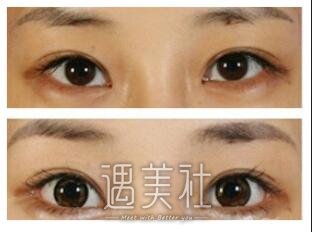 重庆,韩式开眼角,价格大概多少
