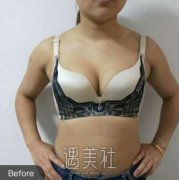 水滴型假体隆胸案例分享，还有前后对比果图片~ width=
