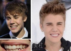 贾斯汀比伯隐形牙套皂片曝光，小伙子也矫正牙齿？ width=