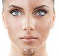 医院做个果酸换肤多少钱?公立和私立的差异大吗? width=