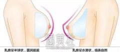 蜜桃假体隆胸果好吗?蜜桃假体隆胸果图片分享~ width=