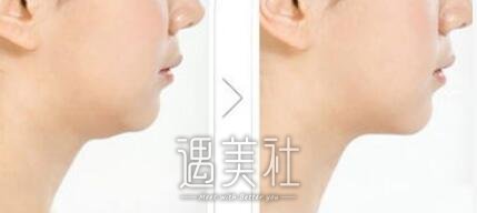 镭射溶脂,有果吗,果图片