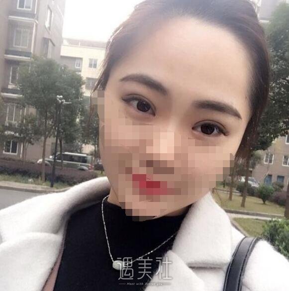 广州曙光王娟做双眼皮怎么样?真实案例分享~
