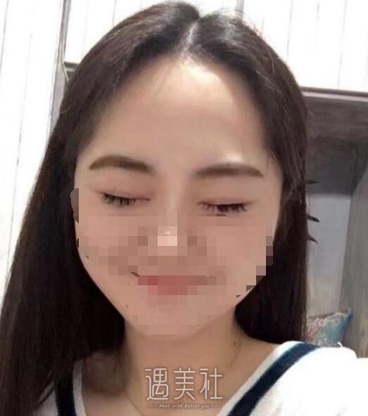 广州曙光王娟做双眼皮怎么样?真实案例分享~