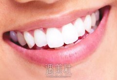 洗牙结石多少钱一次？各个地方收费不同吧？ width=