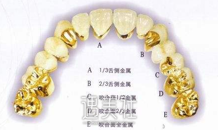 上海烤瓷牙价格表谁有啊?想去上海做烤瓷牙呢!
