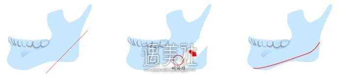 佛山肥胖下颌角整容价格贵吗?要准备多少预算?
