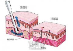 鞍山做腿部光纤微创溶脂多少钱?会不会很贵? width=