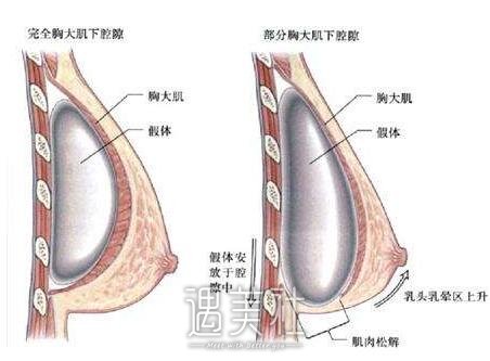 长春丰胸手术一般多少钱?费用大概哪个范围?