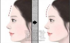 额头填充术有没有副作用?额头填充术前请看下! width=