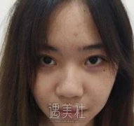 鼻孔缩小手术对比图|鼻孔缩小手术案例分享~ width=